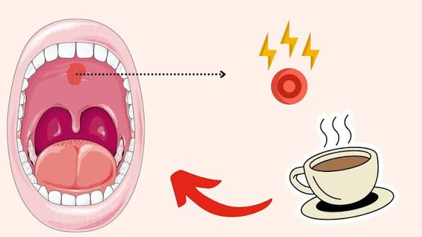 How To Heal A Burn On The Roof Of Mouth