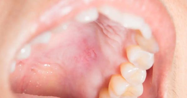 Small Bump On Roof Of Mouth: Why It Comes and Goes