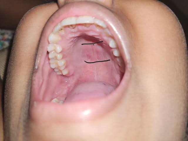 What Is The Bump On The Roof Of My Mouth